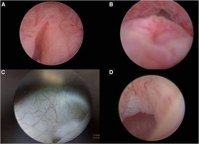 Is cystourethroscopy a crucial preoperative step in severe and complex types of hypospadias?